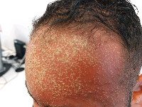 ALEP, acute localized exanthematous pustulosis