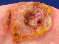 agressief CD8-positief epidermotroop cutaan T-cel lymfoom