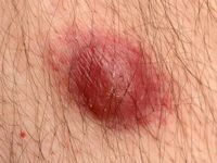 agressief CD8-positief epidermotroop cutaan T-cel lymfoom