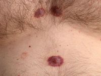 agressief CD8-positief epidermotroop cutaan T-cel lymfoom