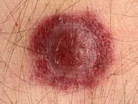 agressief CD8-positief epidermotroop cutaan T-cel lymfoom