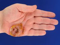 agressief CD8-positief epidermotroop cutaan T-cel lymfoom