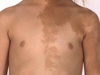 McCune-Albright syndroom