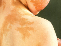 McCune-Albright syndroom