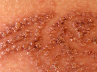Contactallergie voor henna tatoeage
