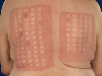 Plakproef type IV allergie