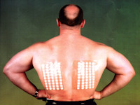 Plakproef type IV allergie