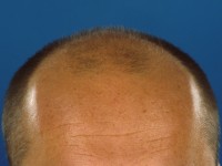 Androgenetic alopecia