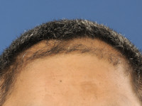 Alopecia androgenetica