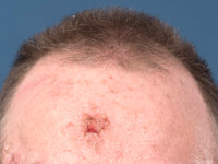 Alopecia androgenetica