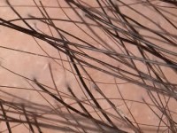 Alopecia androgenetica