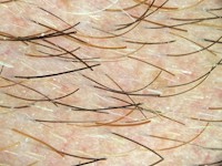 Alopecia areata