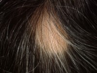 Alopecia areata