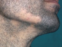 Alopecia areata