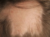 Alopecia areata