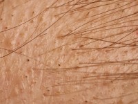 Alopecia areata