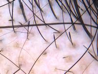 Alopecia areata