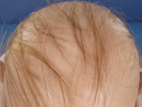 alopecia diffusa (diffuse hair loss)