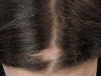 Alopecia triangularis congenita