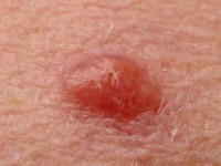 Amelanotisch melanoom