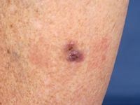 Amelanotisch melanoom