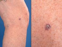 Amelanotisch melanoom