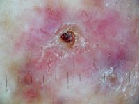 Amelanotisch melanoom