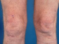 Amelanotisch melanoom