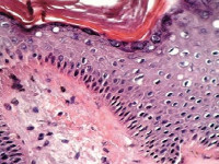 Amyloid deposities sub-epidermaal