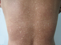 Amyloidosis cutis dyschromica