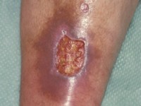 Ulcus bij ANCA's en Factor V Leiden