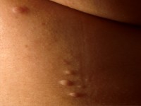 Anetodermie, anetodermia