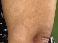 Anetodermie, anetodermia