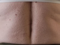 Anetodermie, anetodermia