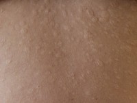 Anetodermie, anetodermia