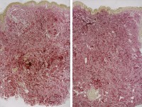 Anetodermie, anetodermia