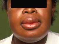 Angioedema (Quincke's edema)