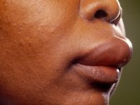 Angioedema (Quincke's edema)