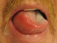 Angioedema (Quincke's edema)