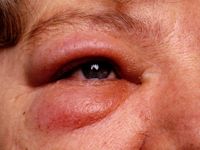 Angioedema (Quincke's edema)
