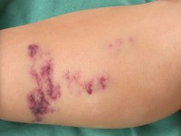 Angiokeratoma corporis circumscriptum