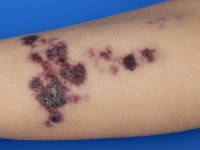 Angiokeratoma corporis circumscriptum