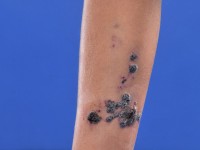 Angiokeratoma corporis circumscriptum