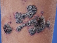 Angiokeratoma corporis circumscriptum