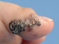 Angiokeratoma Mibelli