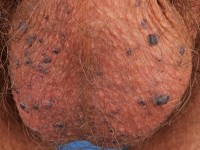 Angiokeratoma scrotale (Fordyce)