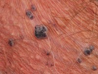 Angiokeratoma scrotale (Fordyce)