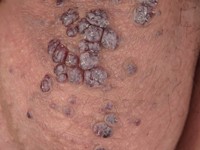 Angiokeratoma scrotale (Fordyce)