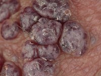 Angiokeratoma scrotale (Fordyce)