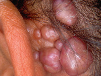 Angiolymphoid hyperplasia with eosinophilia